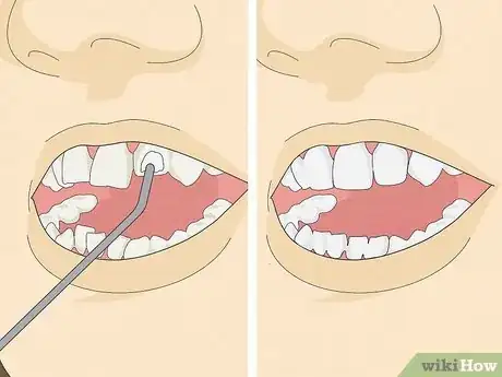 Image titled Straighten Your Teeth Without Braces Step 19