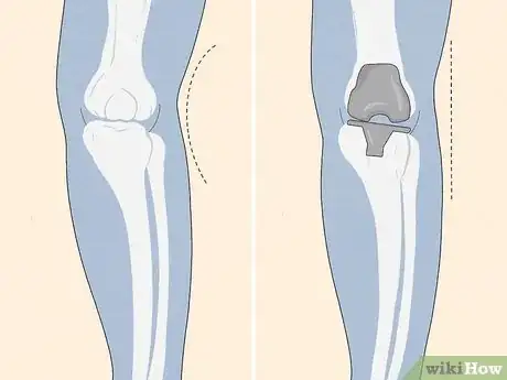 Image titled Fix Knock Knees Step 14