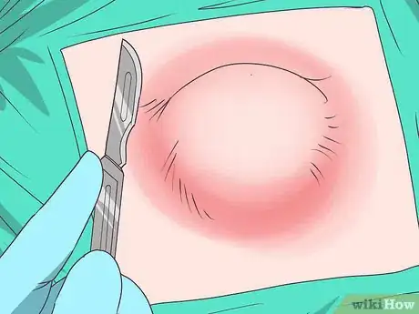 Image titled Drain a Cyst Step 2