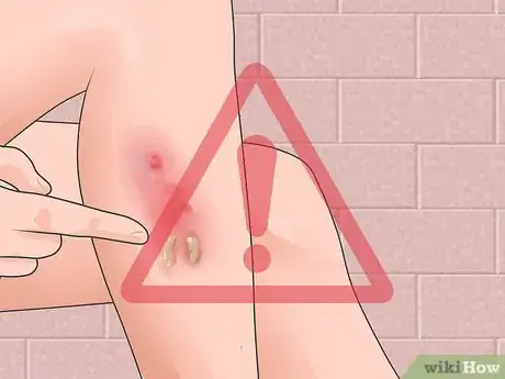 Image titled Ease the Symptoms of Spongiotic Dermatitis Step 2