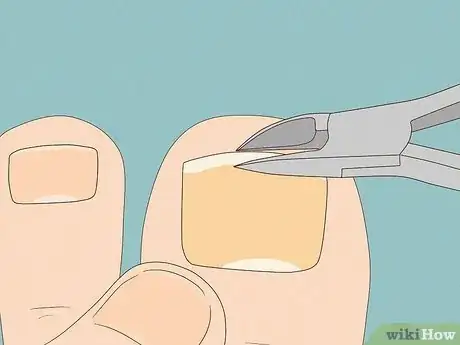 Image titled Remove a Dead Toenail Step 8