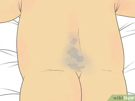 Image titled Know What to Expect on a Newborn's Skin Step 11