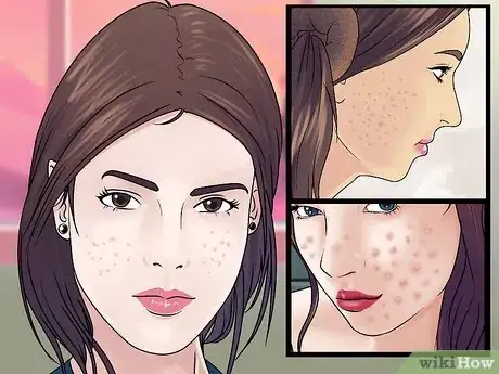 Image titled Prevent Acne Scars Step 1