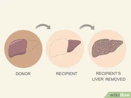 Image titled Diagnose a Fatty Liver Step 21