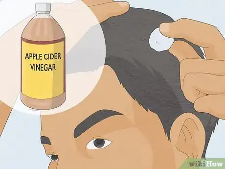 Image titled Make Your Scalp Stop Itching Step 8