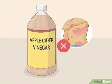 Image titled Use Apple Cider Vinegar for Psoriasis Step 1