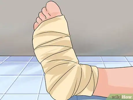 Image titled Tape a Foot for Plantar Fasciitis Step 5