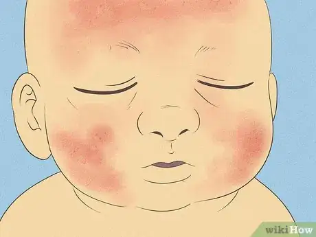 Image titled Know What to Expect on a Newborn's Skin Step 12