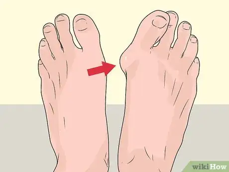 Image titled Check Feet for Complications of Diabetes Step 6