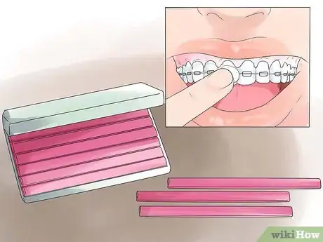 Image titled Eat With Braces Step 12