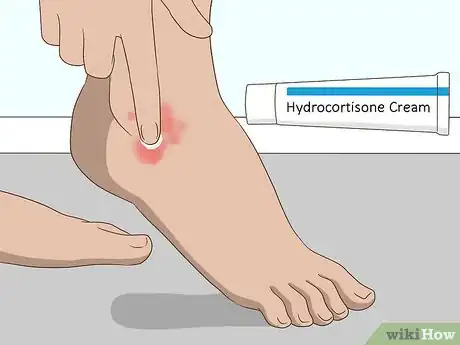 Image titled Reduce Bug Bite Swelling Step 11