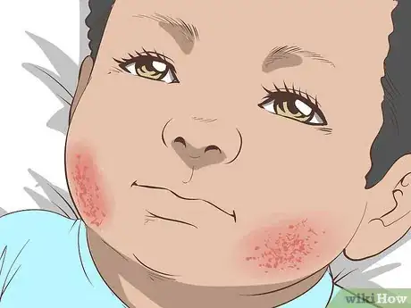 Image titled Identify and Treat Different Types of Diaper Rash Step 6