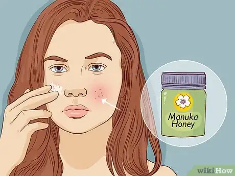 Image titled Get Clear Skin Fast and Naturally Step 6