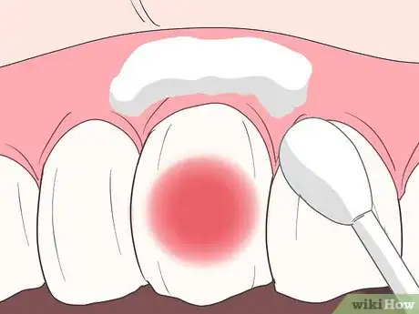 Image titled Stop Toothache Pain Fast Step 17