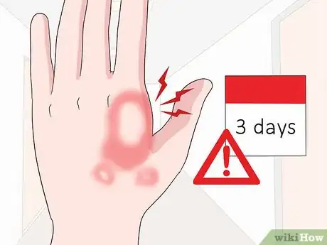 Image titled Reduce Bug Bite Swelling Step 15