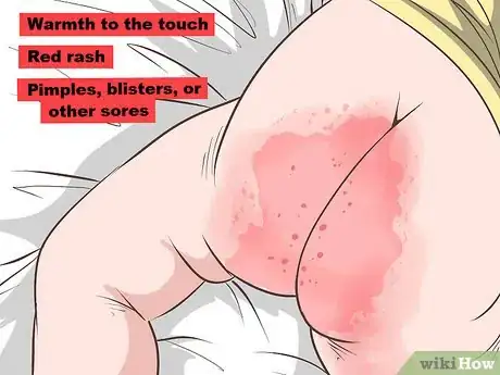 Image titled Identify and Treat Different Types of Diaper Rash Step 1