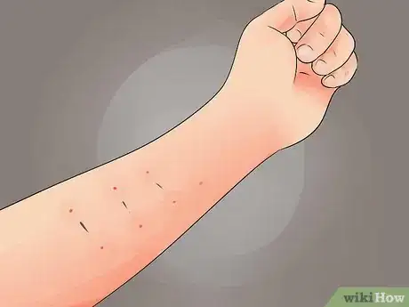 Image titled Tell if a Tattoo Is Infected Step 9