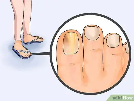 Image titled Get Rid of Toe Fungus Step 1