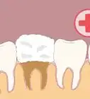 Prevent Dry Socket After a Tooth Extraction