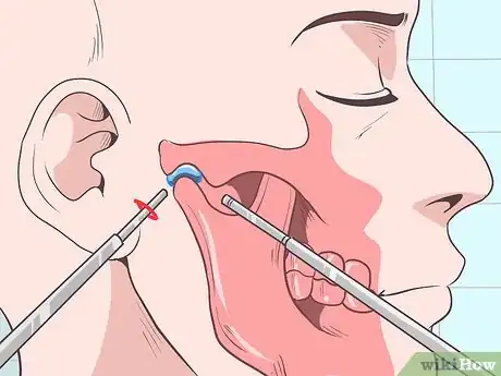 Image titled Alleviate Temporomandibular Joint Disorder (TMD) Step 19