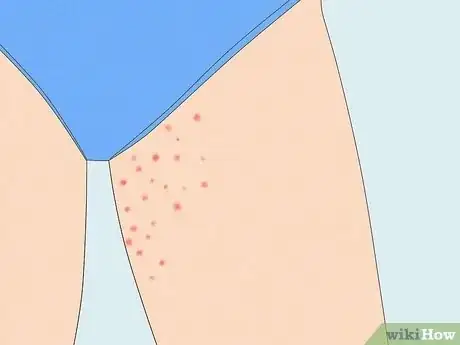 Image titled Identify Insect Bites Step 6