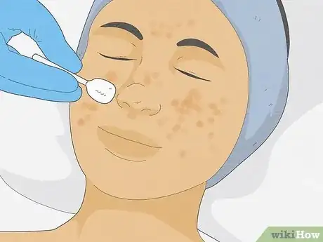 Image titled Get Rid of Cystic Acne Scars Step 11