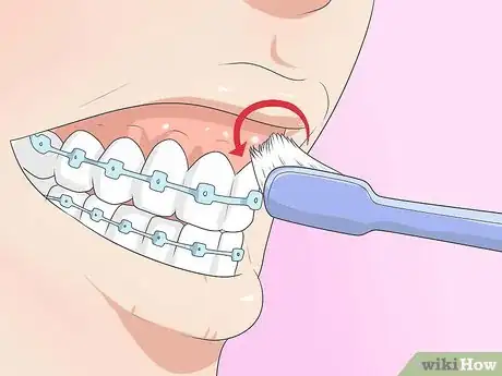 Image titled Make Your Braces Hurt Less Step 5