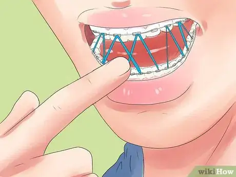 Image titled Alleviate Orthodontic Brace Pain Step 11