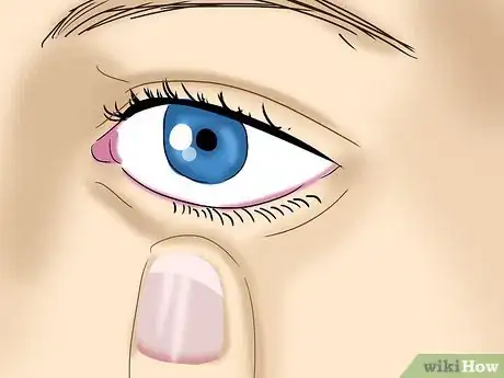 Image titled Take Out Contact Lenses Without Touching Your Eye Step 6