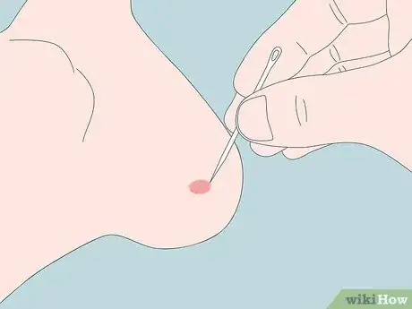 Image titled Treat a Blister on Your Heel Step 9