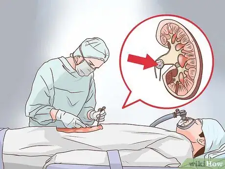 Image titled Know if You Have Kidney Stones Step 13