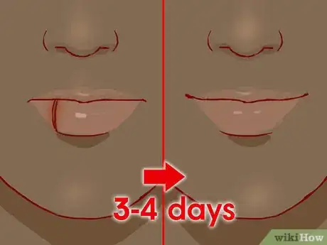 Image titled Treat a Cut Lip Step 11
