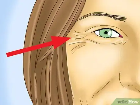 Image titled Take Out Contact Lenses Without Touching Your Eye Step 5