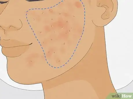 Image titled Get Rid of Cystic Acne Scars Step 14