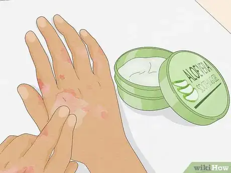 Image titled Use Aloe Vera to Treat Eczema Step 2