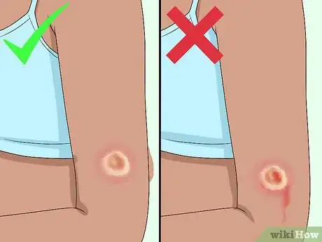 Image titled Get Rid of a Scab Step 1