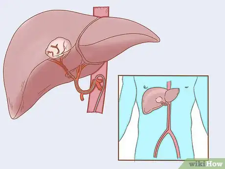 Image titled Treat Liver Cancer Step 12