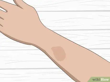 Image titled Remove Birthmarks Step 13