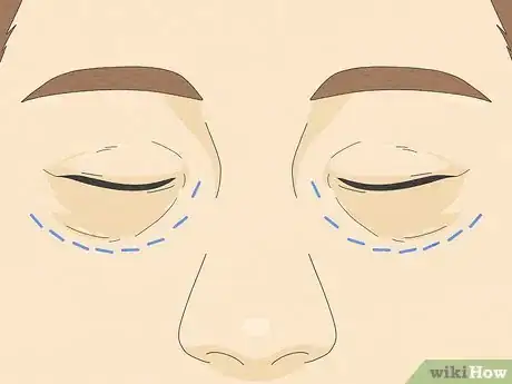 Image titled Reduce Puffy Eyes Step 11