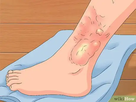 Image titled Determine if a Burn Is Infected Step 4