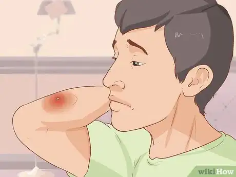 Image titled Take Care of a Wasp Sting Step 10