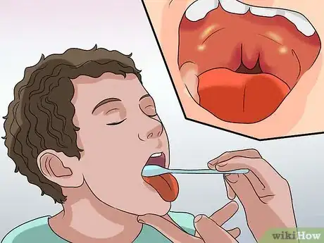 Image titled Diagnose Tonsillitis Step 3