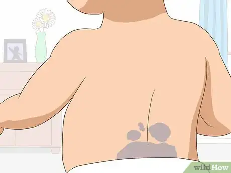 Image titled Remove Birthmarks Step 14