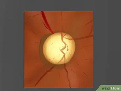 Image titled Use an Ophthalmoscope Step 13