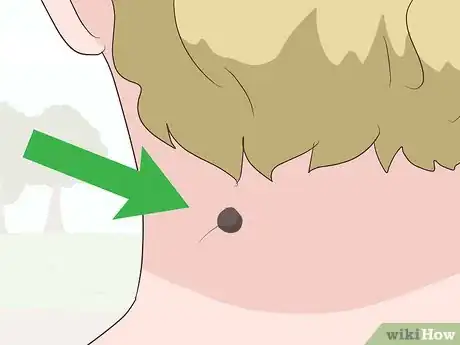 Image titled Remove Birthmarks Step 12