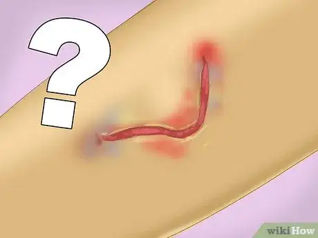 Image titled Treat a Skin Flap or Abrasion During First Aid Step 5