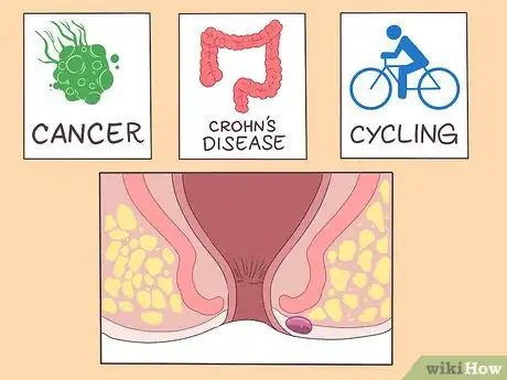 Image titled Prevent Perianal Abscess from Returning Step 13