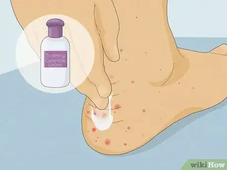 Image titled Treat Sand Flea Bites Step 1