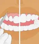 Straighten Your Teeth Without Braces