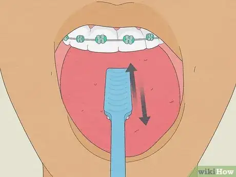 Image titled Brush Your Teeth With Braces On Step 4